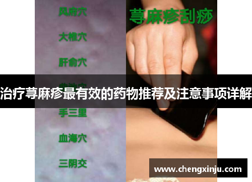 治疗荨麻疹最有效的药物推荐及注意事项详解
