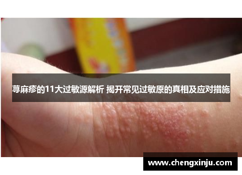 荨麻疹的11大过敏源解析 揭开常见过敏原的真相及应对措施